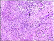 International Journal of Infection Prevention-Chronic
