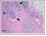 International Journal of Infection Prevention-Chronic