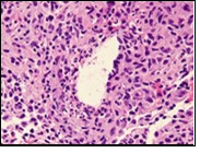 International Journal of Infection Prevention-Chronic