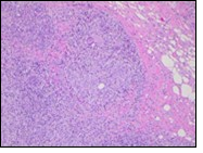 International Journal of Infection Prevention-Chronic