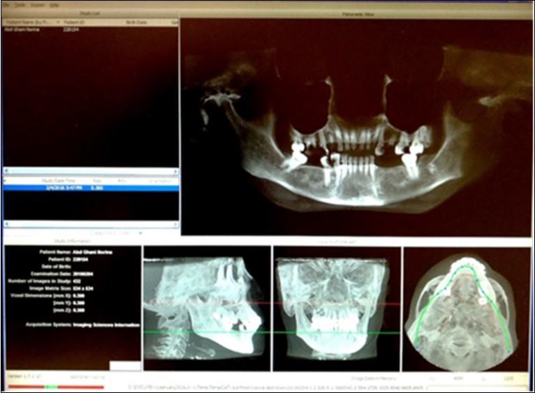 Journal of Big Data Research-Primary maxillary sinus ostium