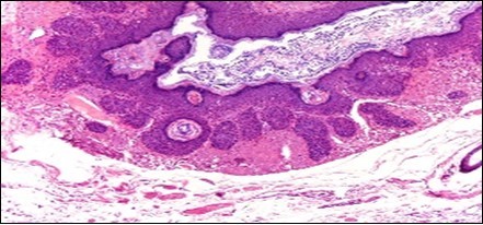 Nevus comedonicus (NC)