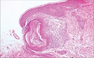 Nevus comedonicus (NC)