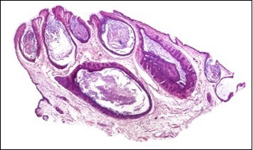 Nevus comedonicus (NC)
