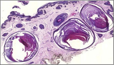 Nevus comedonicus (NC)