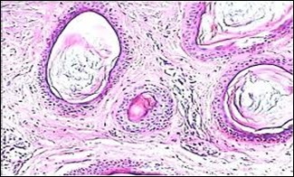 Nevus comedonicus (NC)