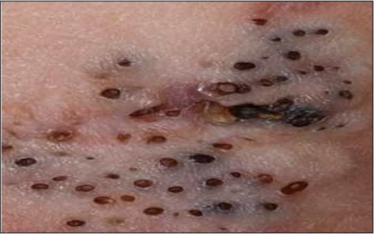 Nevus comedonicus (NC)