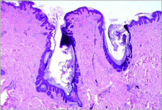 Nevus comedonicus (NC)