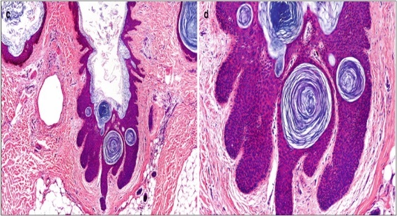 Nevus comedonicus (NC)