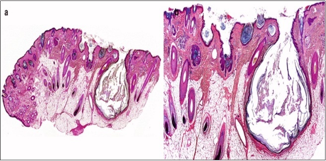 Nevus comedonicus (NC)