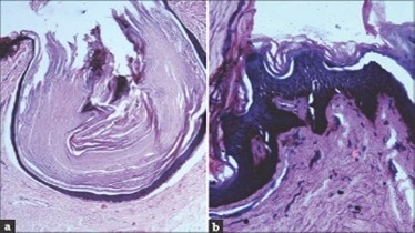 Nevus comedonicus (NC)