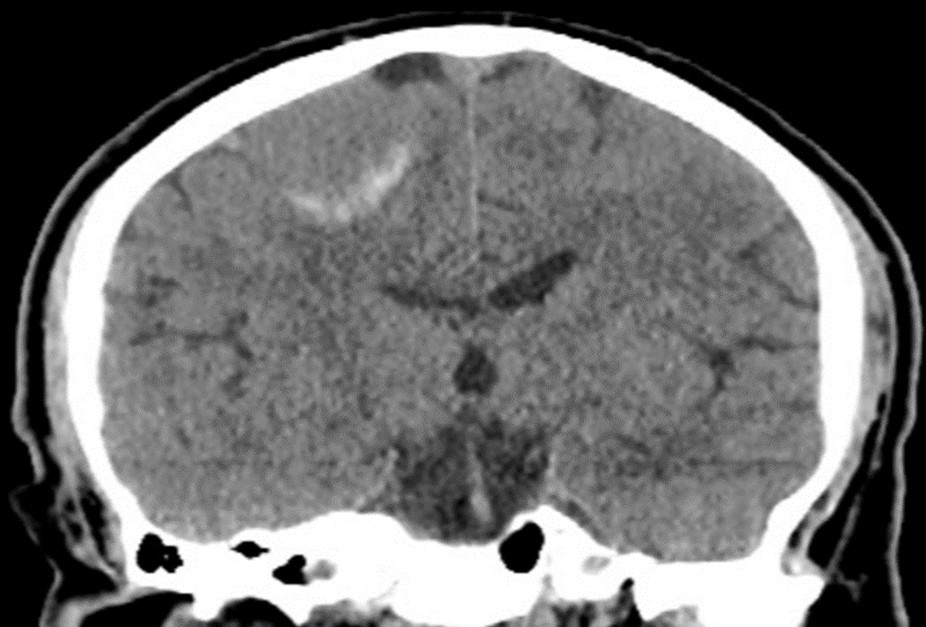 Journal of Hematalogy and Oncology Research-atypical meningioma