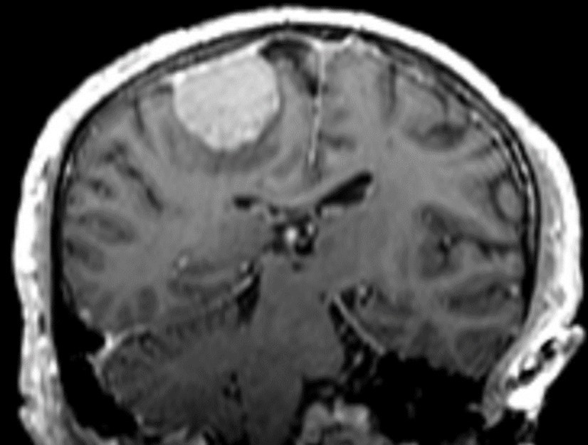 Journal of Hematalogy and Oncology Research-atypical meningioma