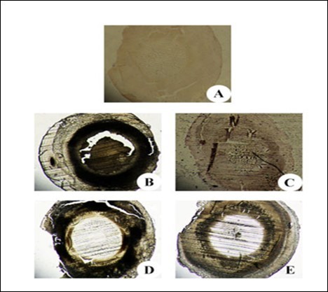 Journal of Ophthalmic Science-Cataract