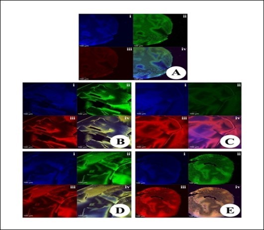 Journal of Ophthalmic Science-Cataract