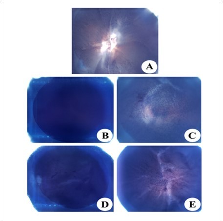 Journal of Ophthalmic Science-Cataract