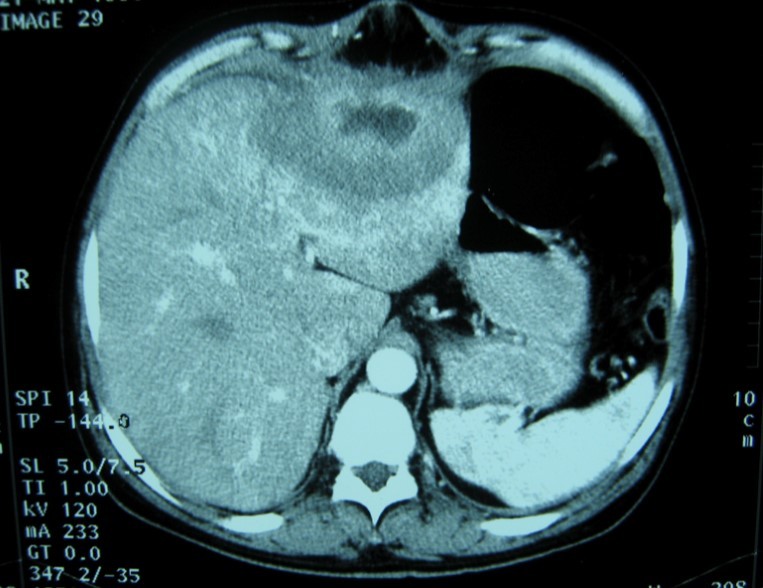 Journal of Spleen And Liver Research-tuberculosis