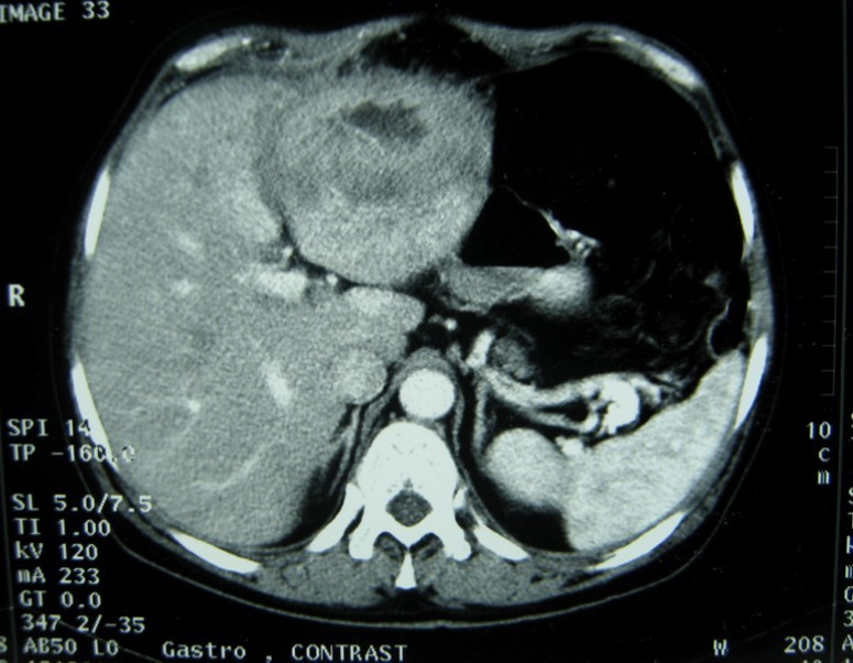 Journal of Spleen And Liver Research-tuberculosis