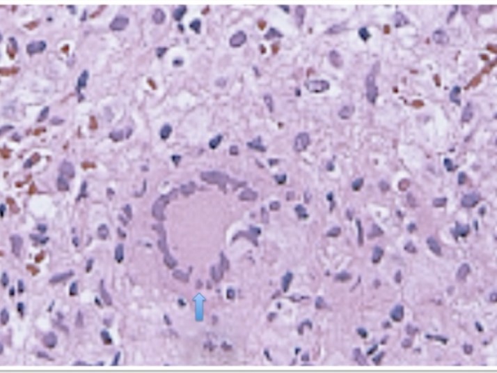 Journal of Spleen And Liver Research-tuberculosis