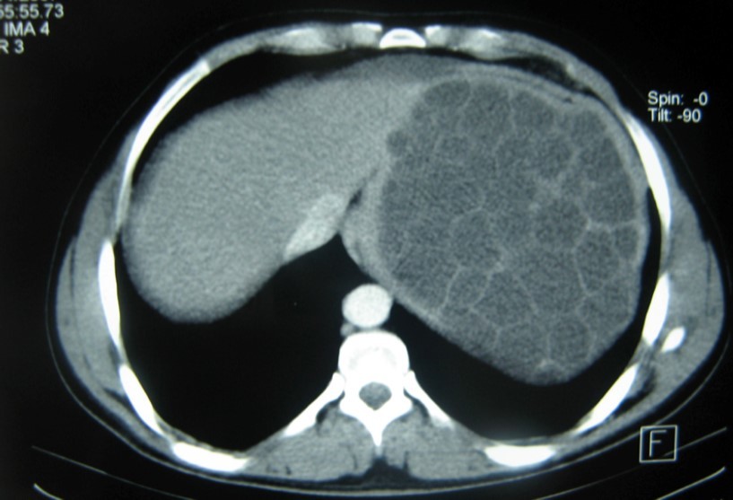 Journal of Spleen And Liver Research-spleen-preserving surgery