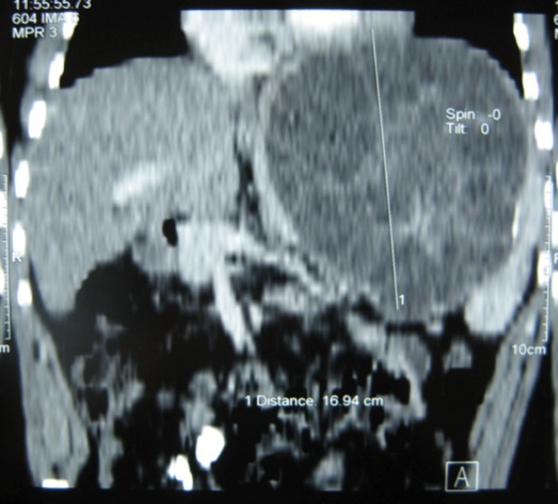 Journal of Spleen And Liver Research-spleen-preserving surgery