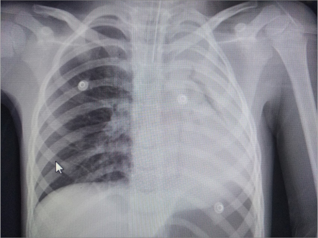 Journal of Preventive Medicine And Care-Plastic bronchitis