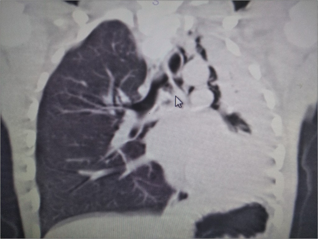 Journal of Preventive Medicine And Care-Plastic bronchitis
