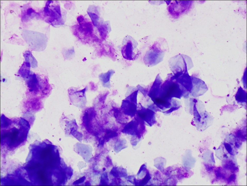 epidermoid Cyst