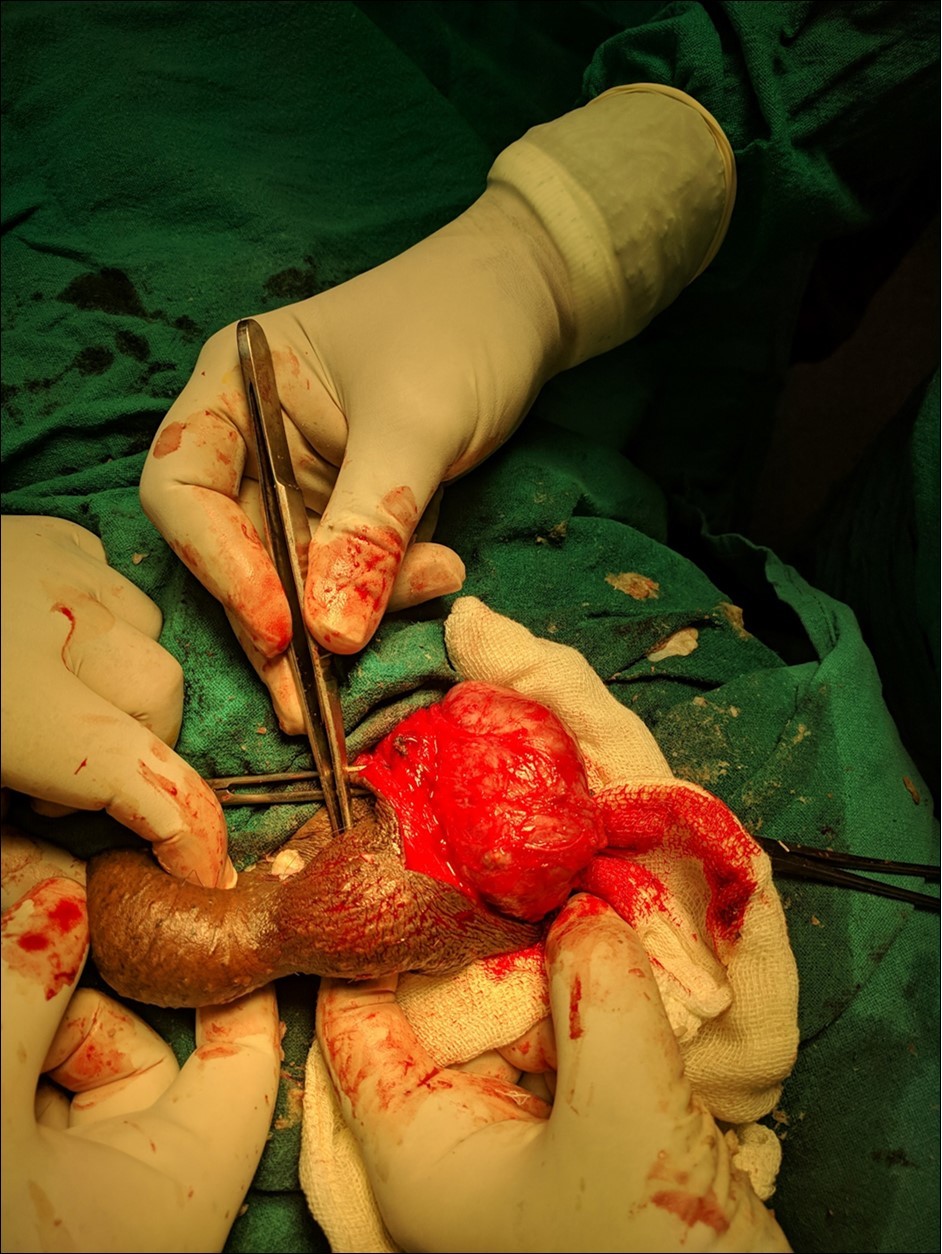 epidermoid Cyst
