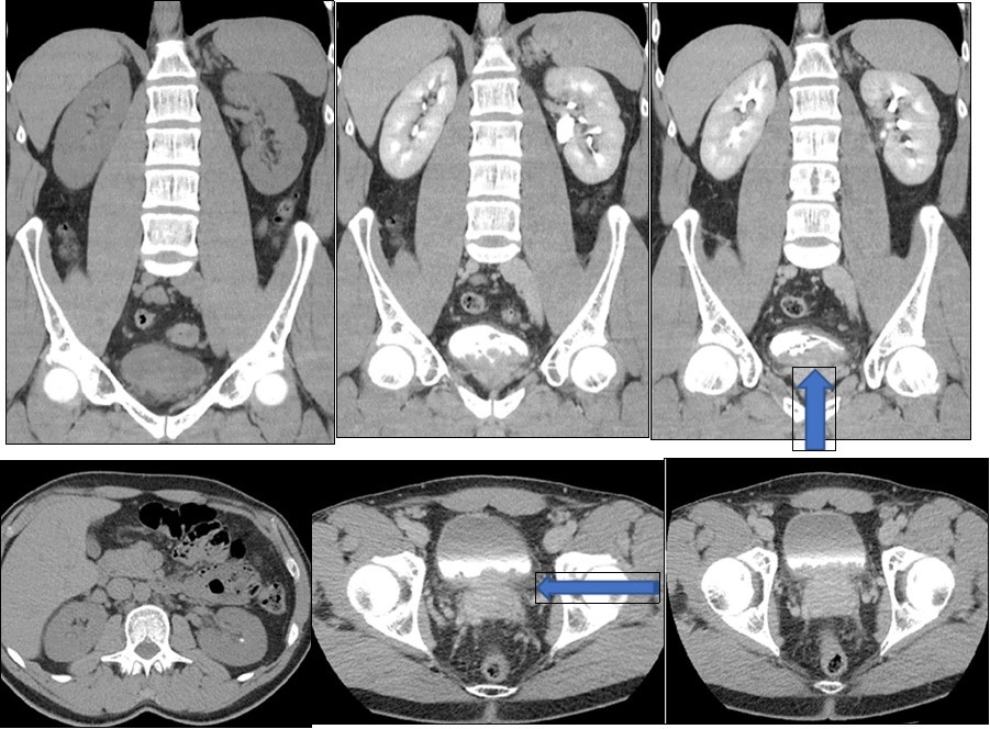 Journal of Digestive Disorders And Diagnosis-glandular cystitis