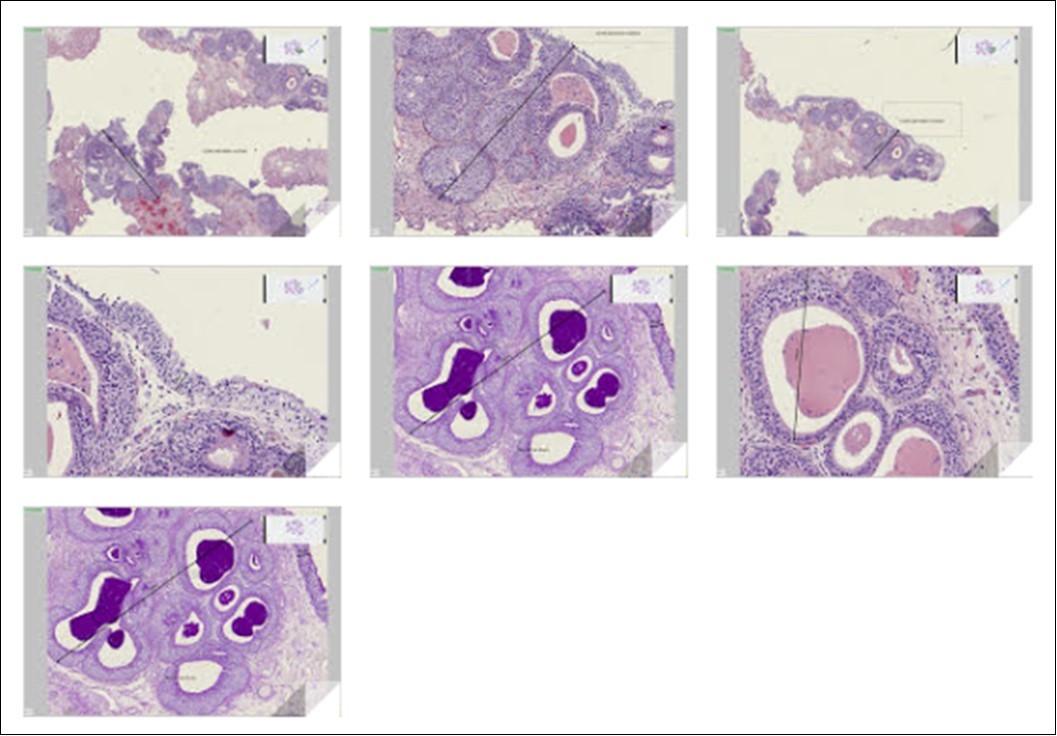 Journal of Digestive Disorders And Diagnosis-glandular cystitis