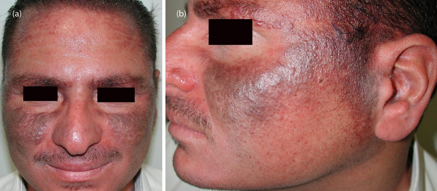 Journal of Dermatologic Research and Therapy-Isotretinoin
