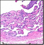 Journal of Dermatologic Research And Therapy-Papillary Endothelial Hyperplasia