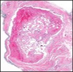 Journal of Dermatologic Research And Therapy-Papillary Endothelial Hyperplasia