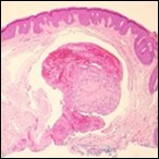 Journal of Dermatologic Research And Therapy-Papillary Endothelial Hyperplasia