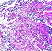 Journal of Dermatologic Research And Therapy-Papillary Endothelial Hyperplasia
