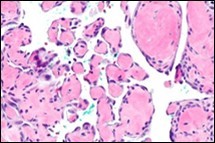 Journal of Dermatologic Research And Therapy-Papillary Endothelial Hyperplasia