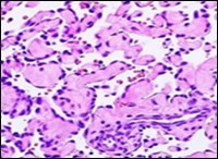 Journal of Dermatologic Research And Therapy-Papillary Endothelial Hyperplasia