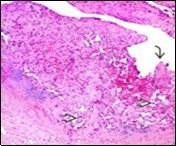 Journal of Dermatologic Research And Therapy-Papillary Endothelial Hyperplasia