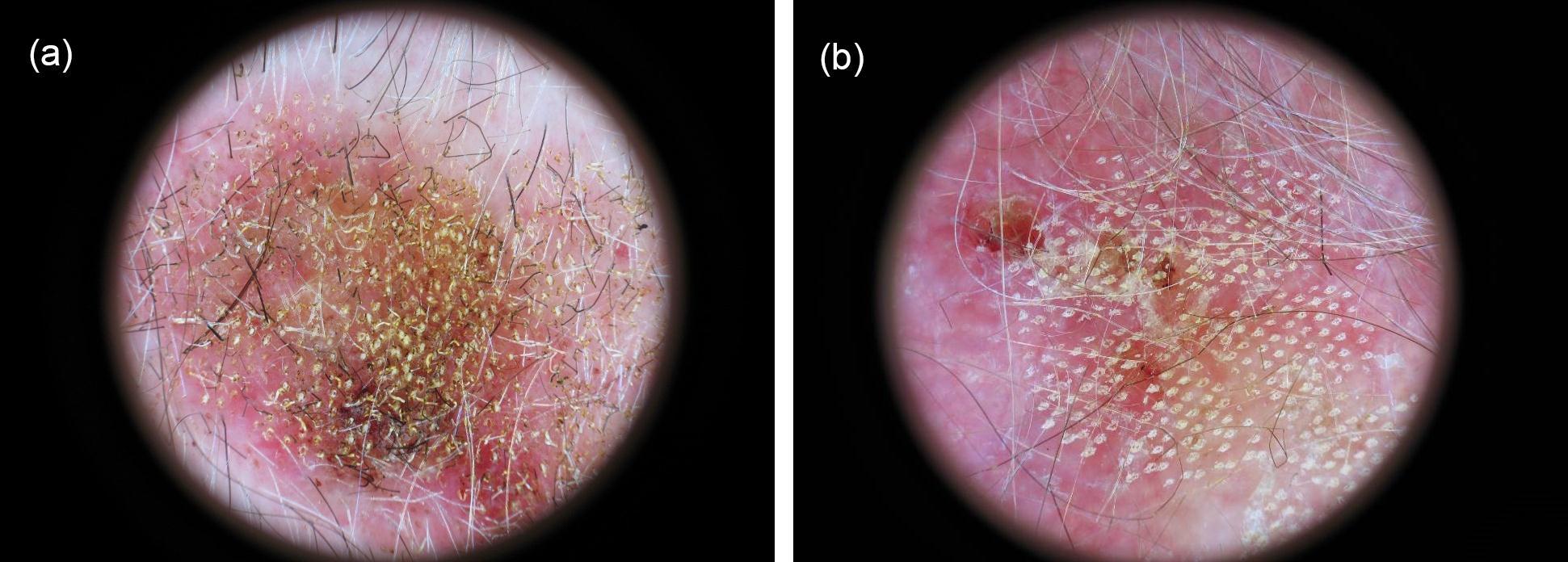 Journal of Dermatologic Research And Therapy-basal cell carcinoma (BCC)