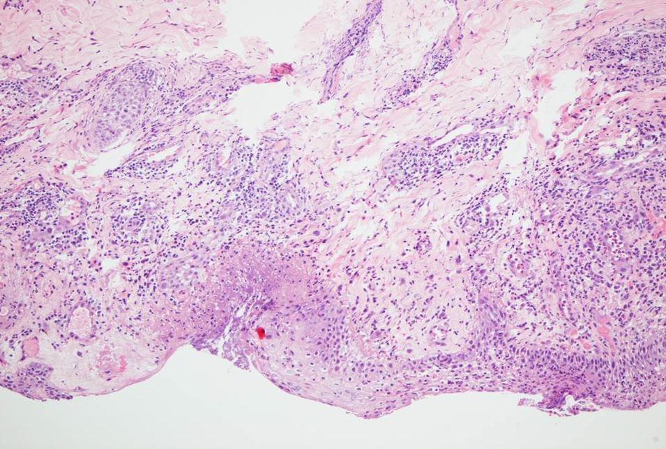 Journal of Dermatologic Research And Therapy-basal cell carcinoma (BCC)