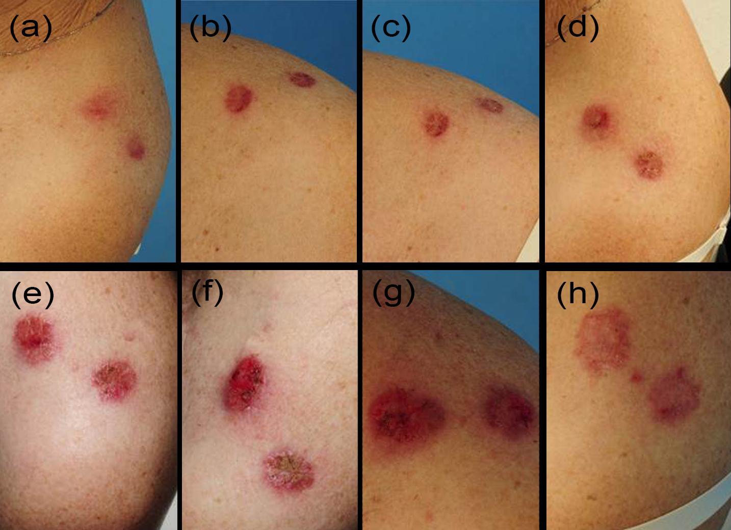 Journal of Dermatologic Research And Therapy-basal cell carcinoma (BCC)