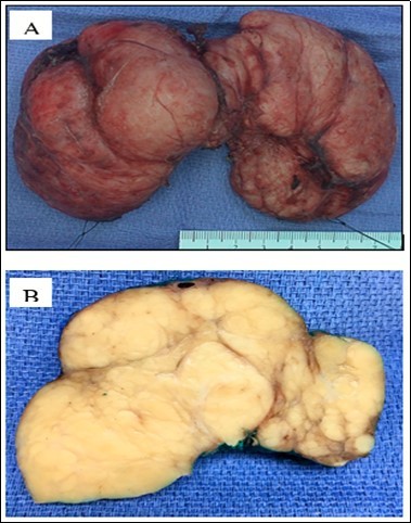 Journal of Hematalogy and Oncology Research-plasmacytoma