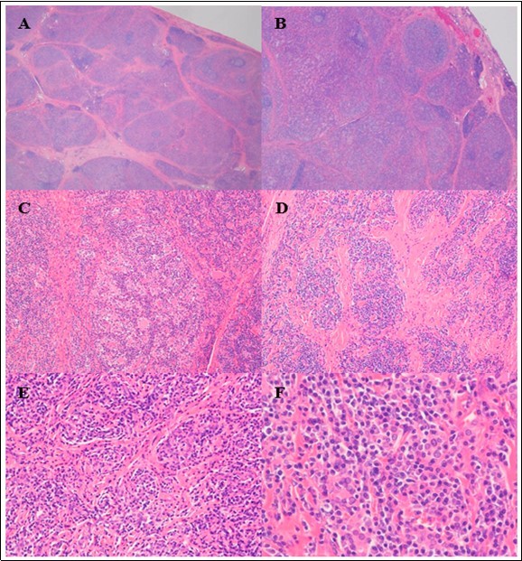 Journal of Hematalogy and Oncology Research-plasmacytoma