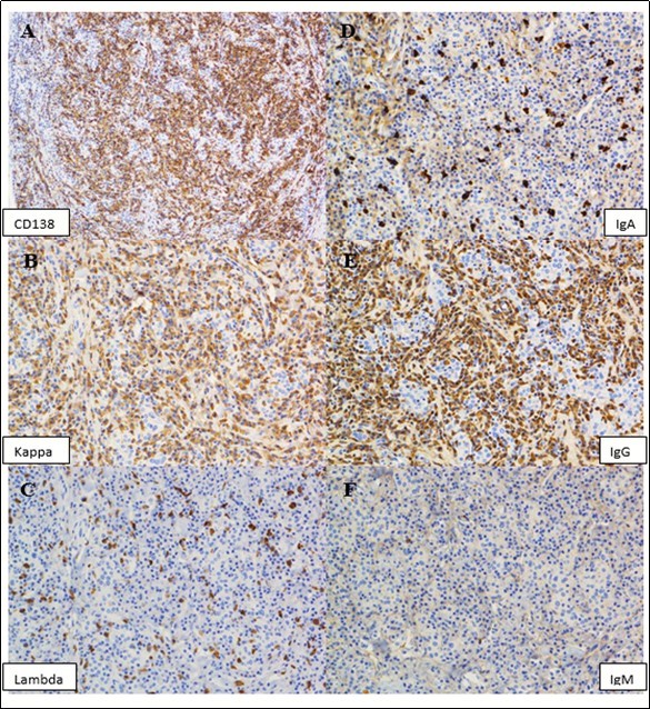 Journal of Hematalogy and Oncology Research-plasmacytoma