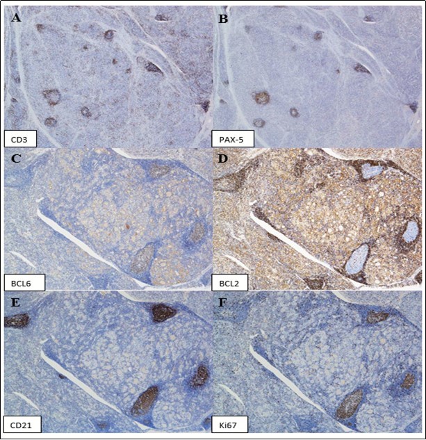 Journal of Hematalogy and Oncology Research-plasmacytoma