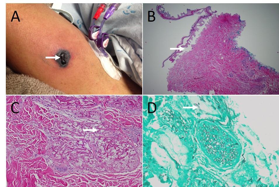 Journal of Dermatologic Research And Therapy-febrile neutropenia