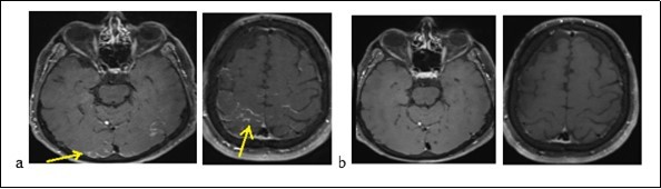 Journal of Neurological Research And Therapy-Reversible posterior encephalopathy syndrome