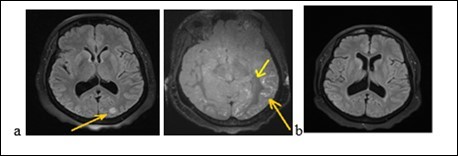 Journal of Neurological Research And Therapy-Reversible posterior encephalopathy syndrome