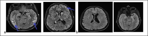 Journal of Neurological Research And Therapy-Reversible posterior encephalopathy syndrome